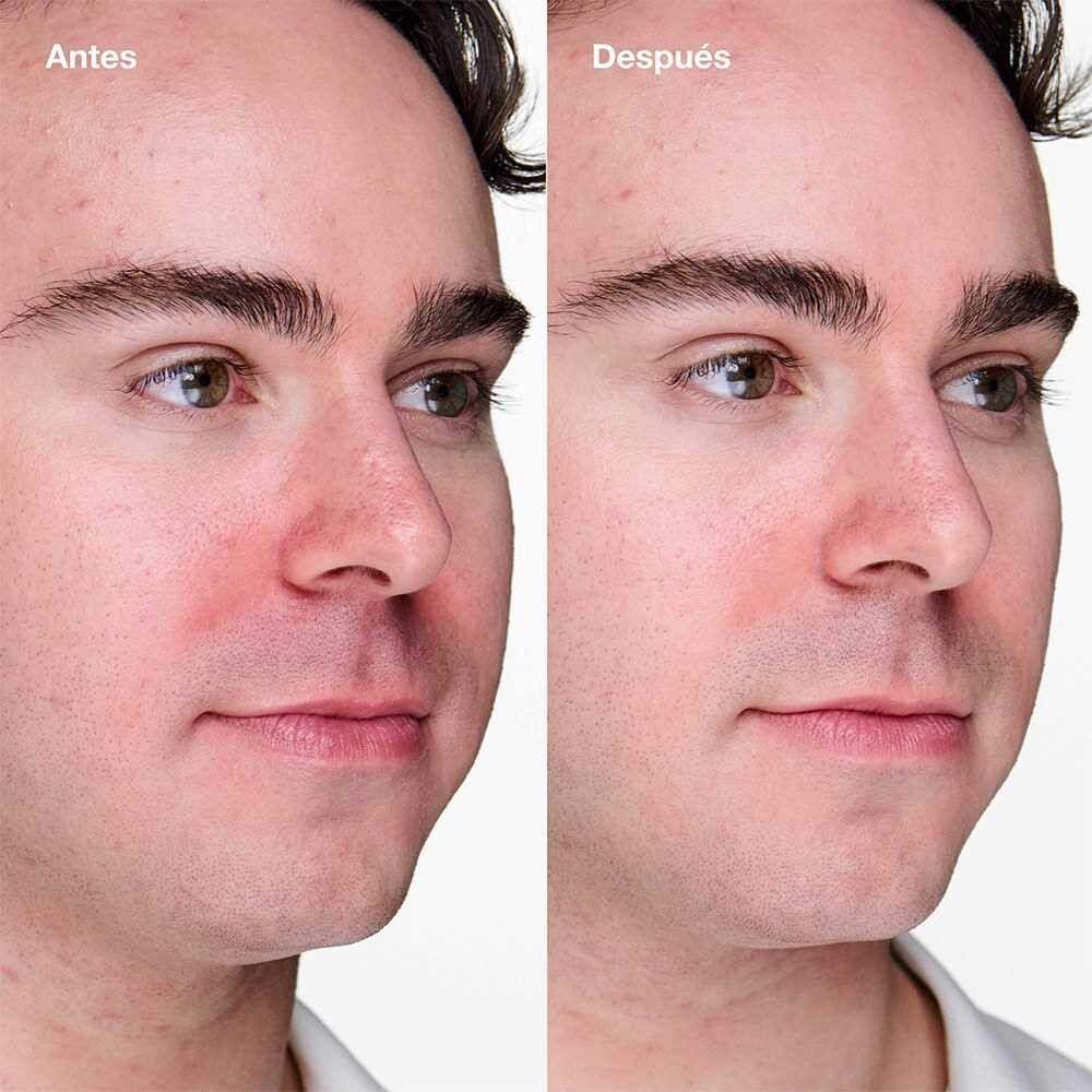 TRATAMIENTO EN GEL PARA PUNTOS NEGROS Y ACNE DE CLINIQUE (GEL CON &Aacute;CIDO SALIC&Iacute;LICO)